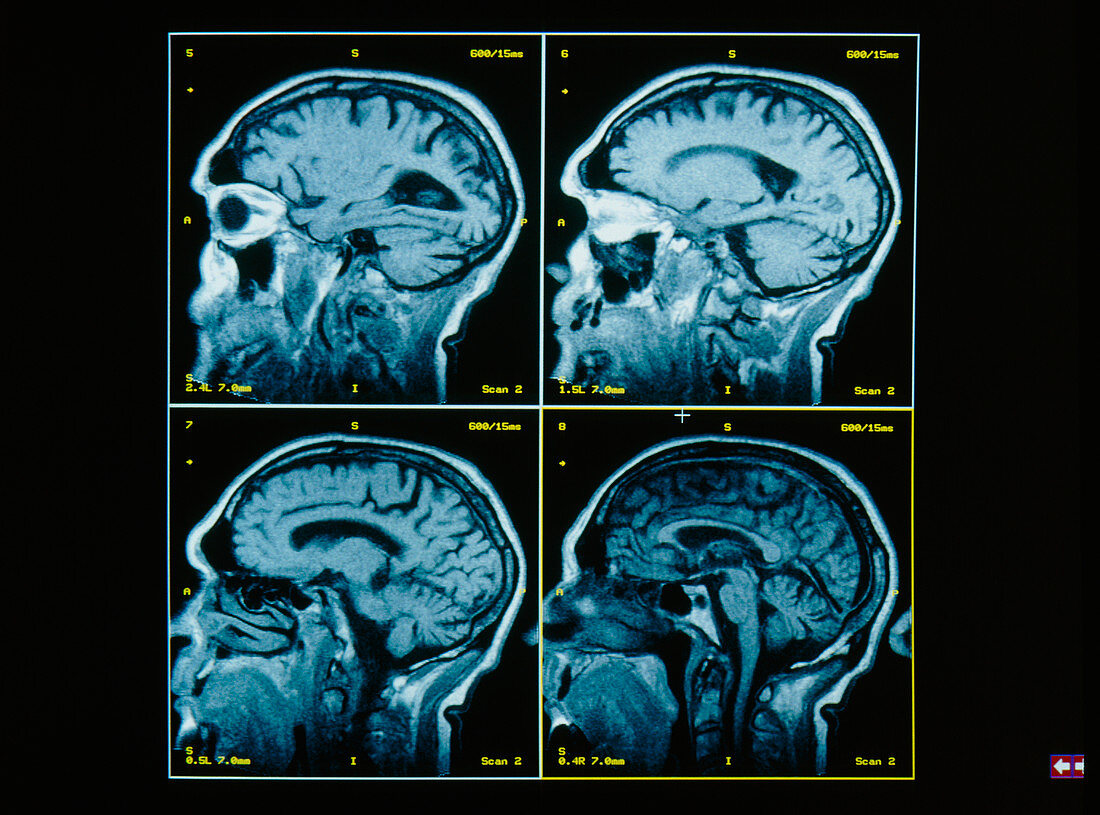 Four MRI scans through the brain,side view