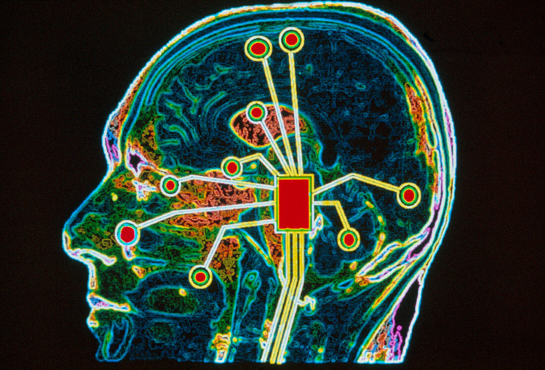 Coloured MRI brain scan with sensory map