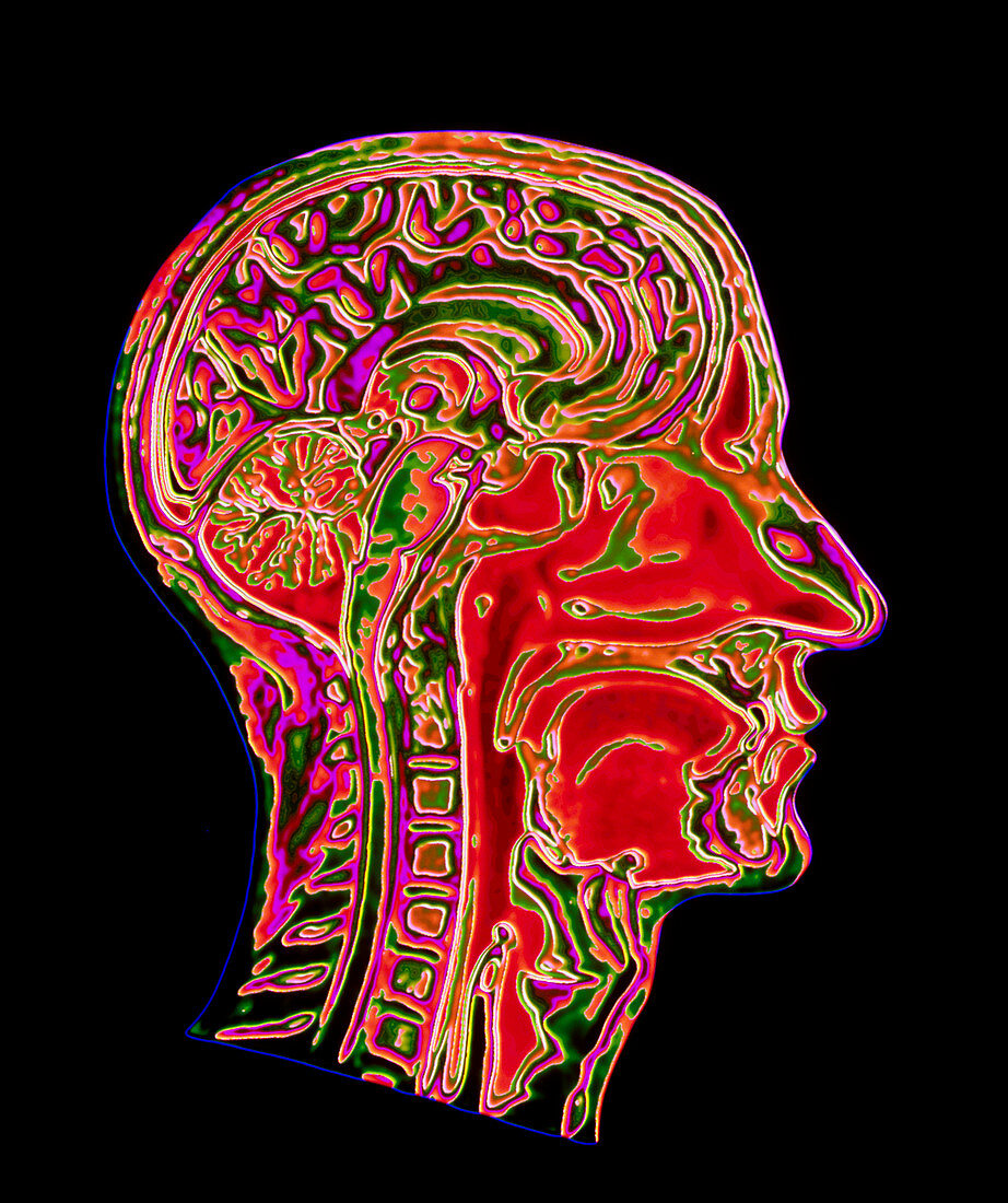 Coloured CT scan of a head showing a healthy brain