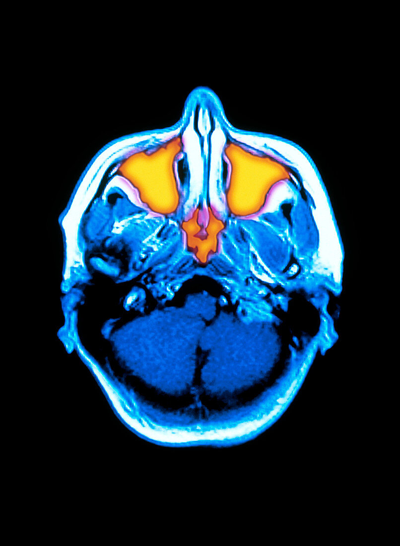 Coloured MRI scan of a person's head & sinuses