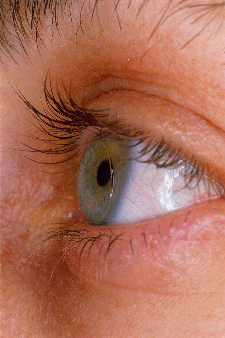 A hard-type contact lens in situ