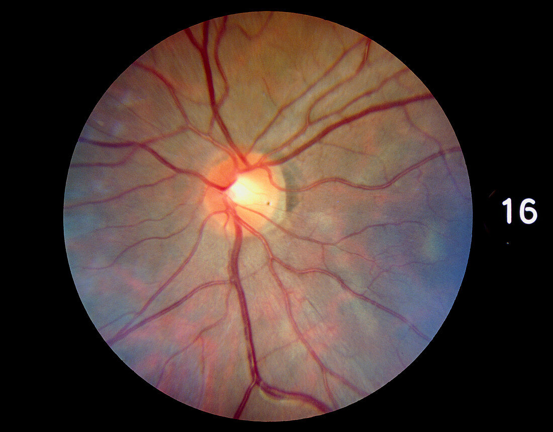 Fundus camera image of a normal retina,Asian