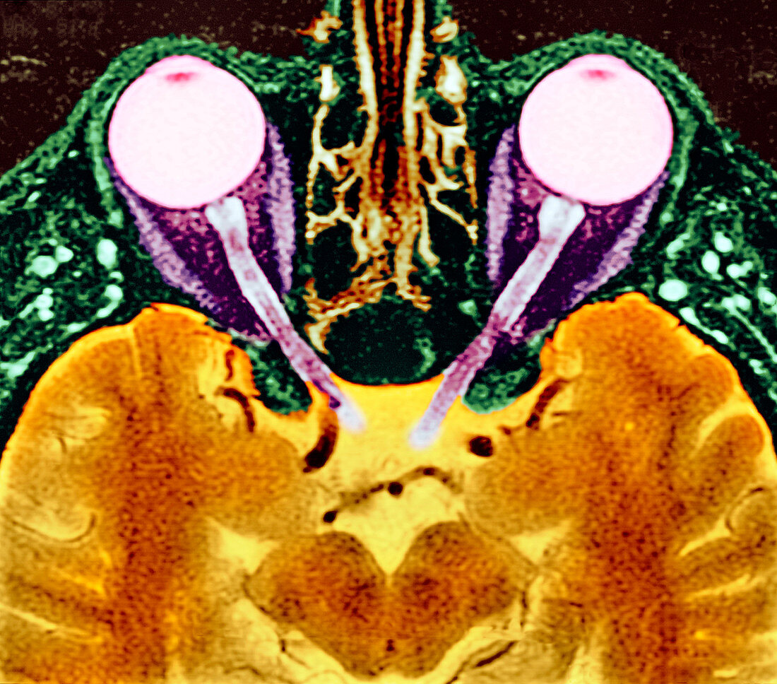 Vision and the brain,MRI scan