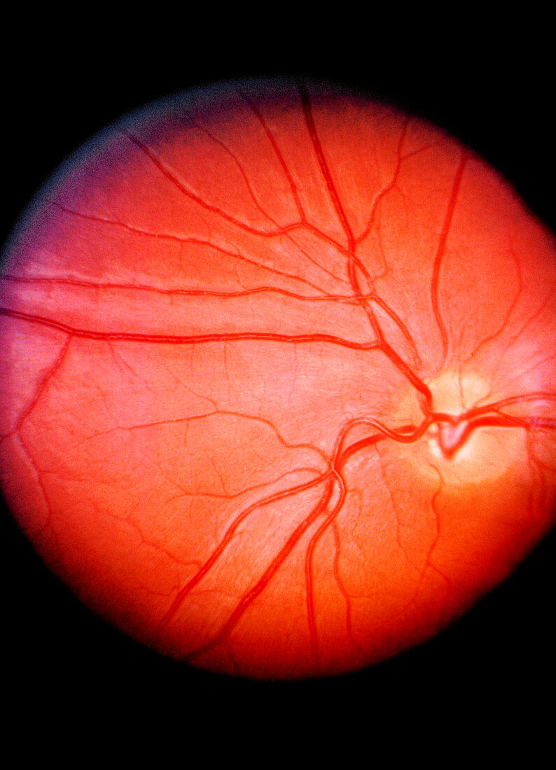 Fundus camera image of a normal retina