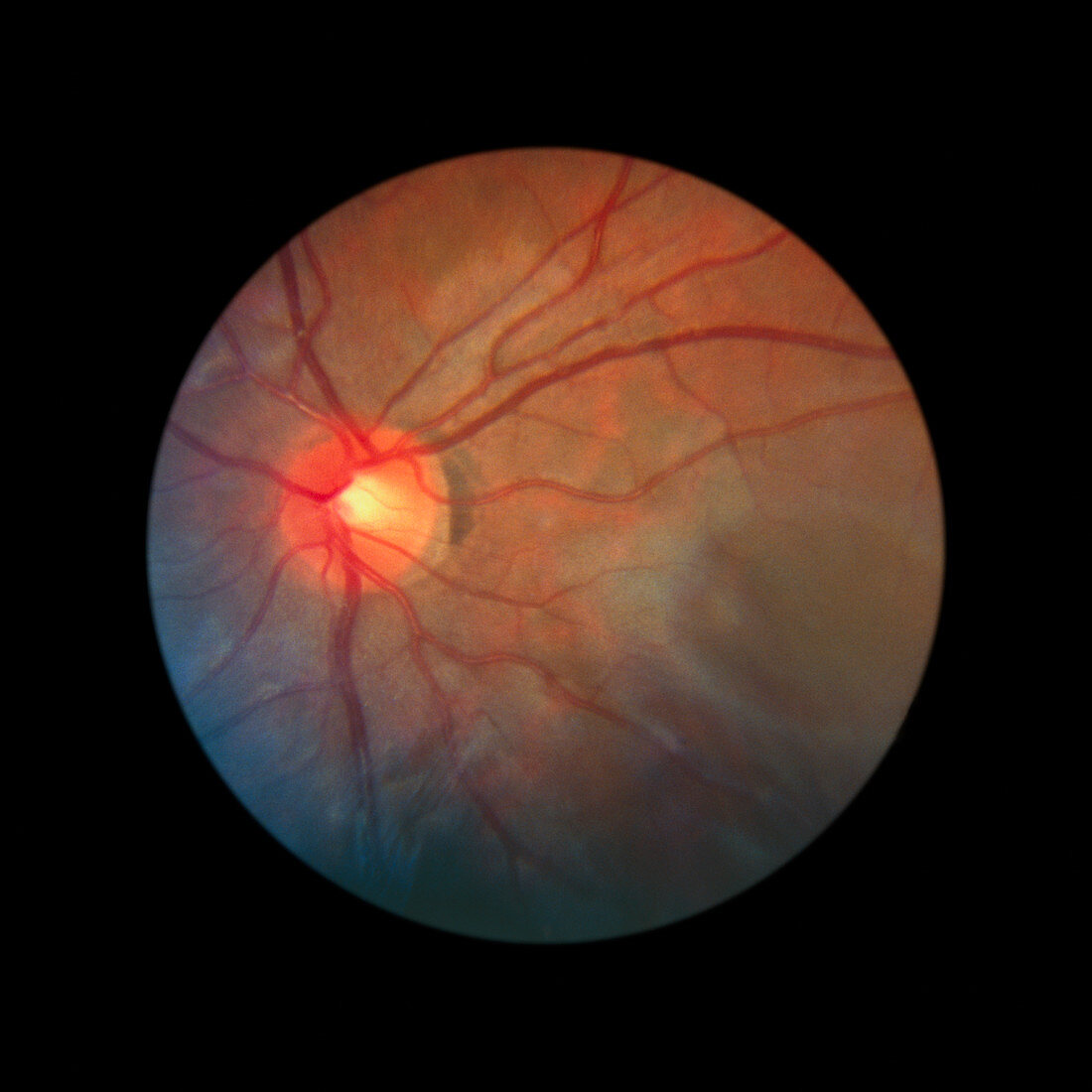 Fundus camera image of a normal retina,Asian