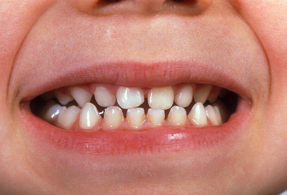 Milk teeth of a four year old boy