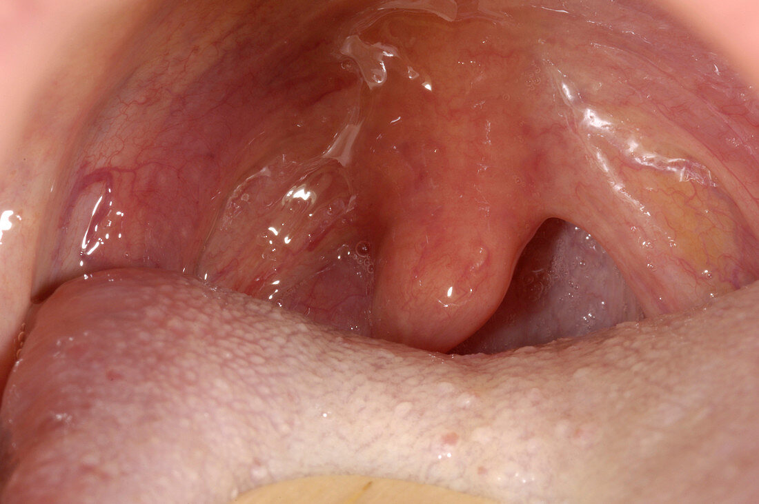 Lymphoid tissue on the throat