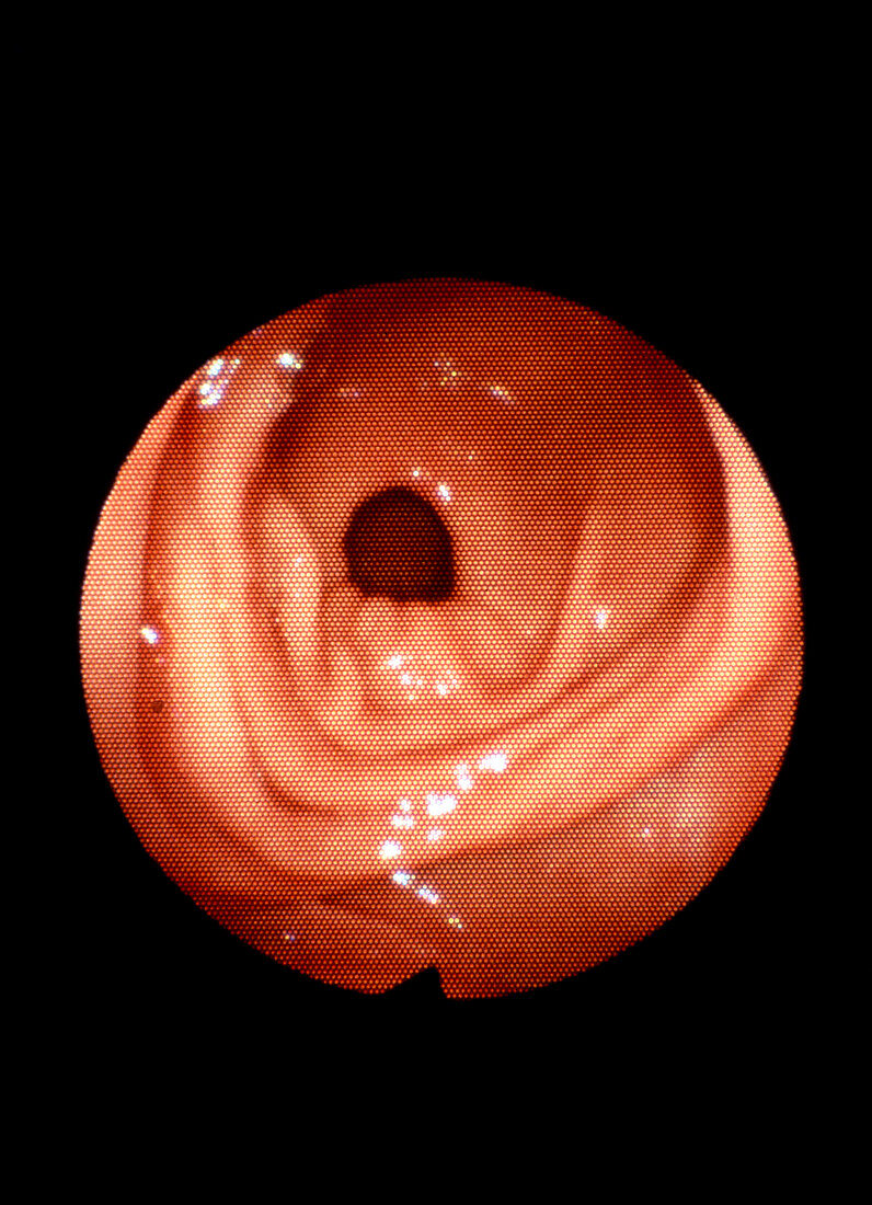 Endoscope image of the human pylorus