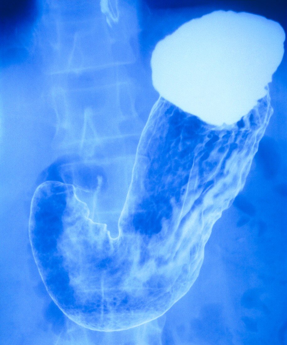 Barium meal X-ray of normal human stomach