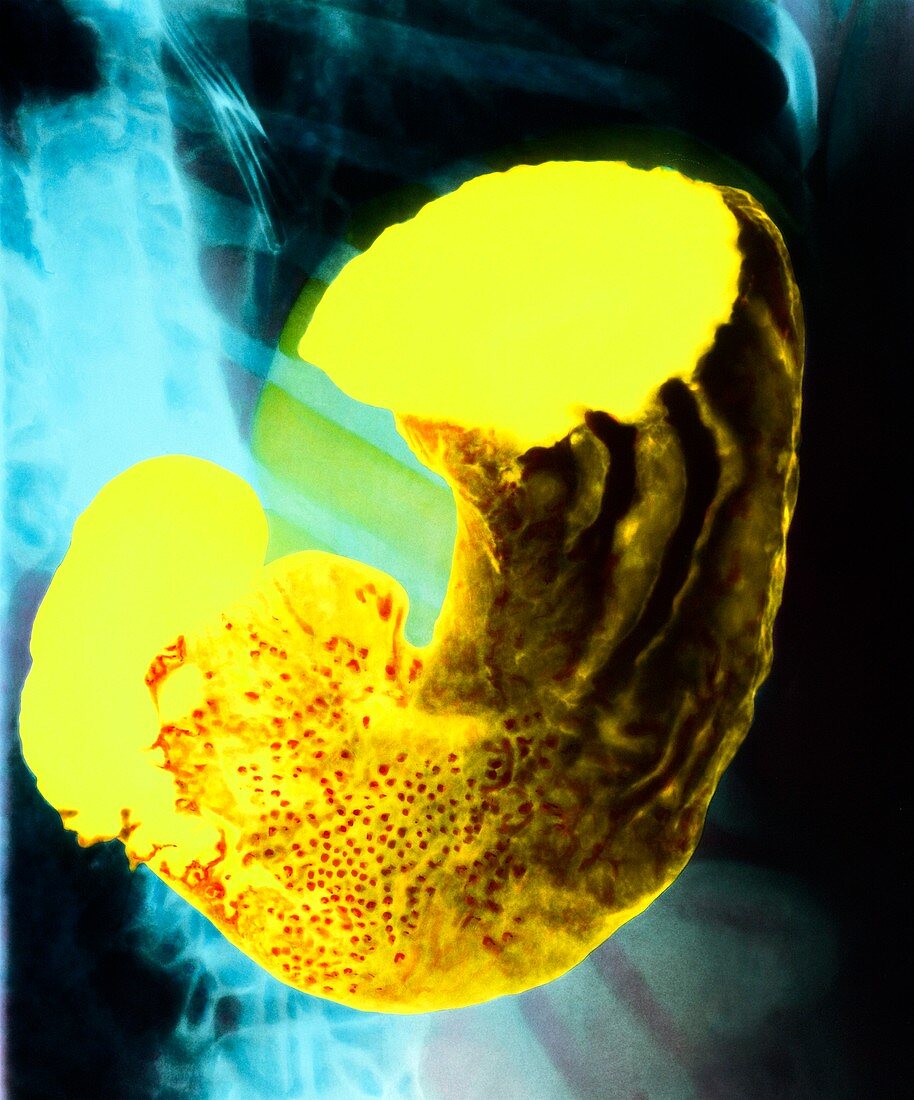 Coloured X-ray of a healthy human stomach
