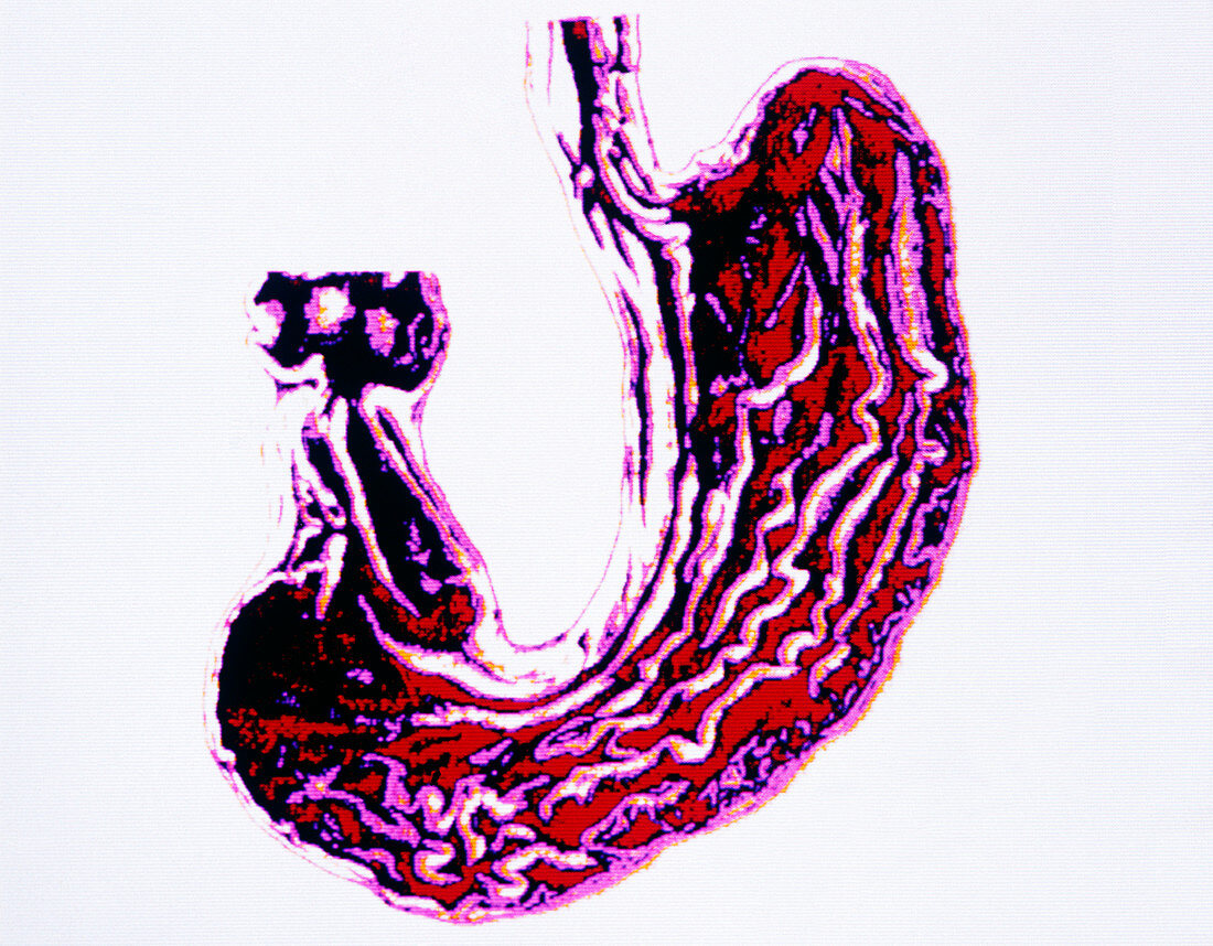 Computer artwork of stomach and lower oesophagus