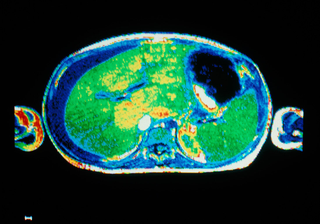 False-colour NMR image of the human liver & spleen