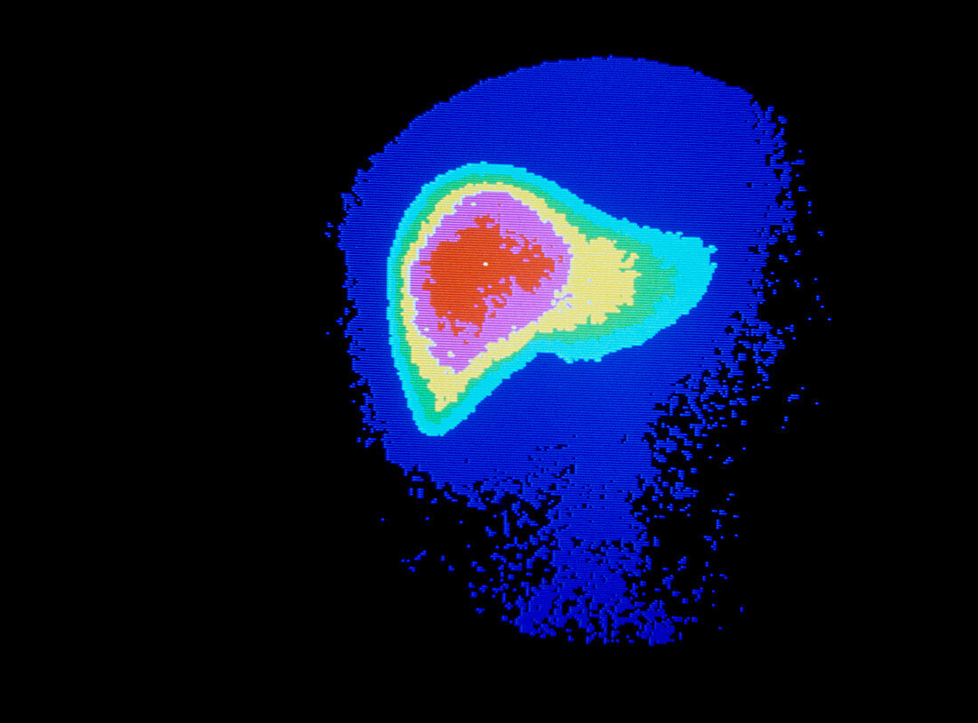 False-col gamma scintigram of normal human liver