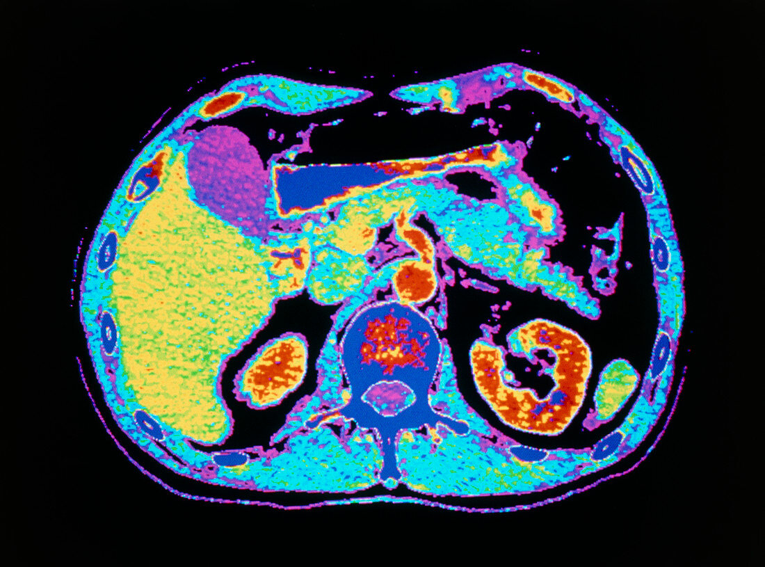 False-colour CT scan: liver; gall bladder; kidneys