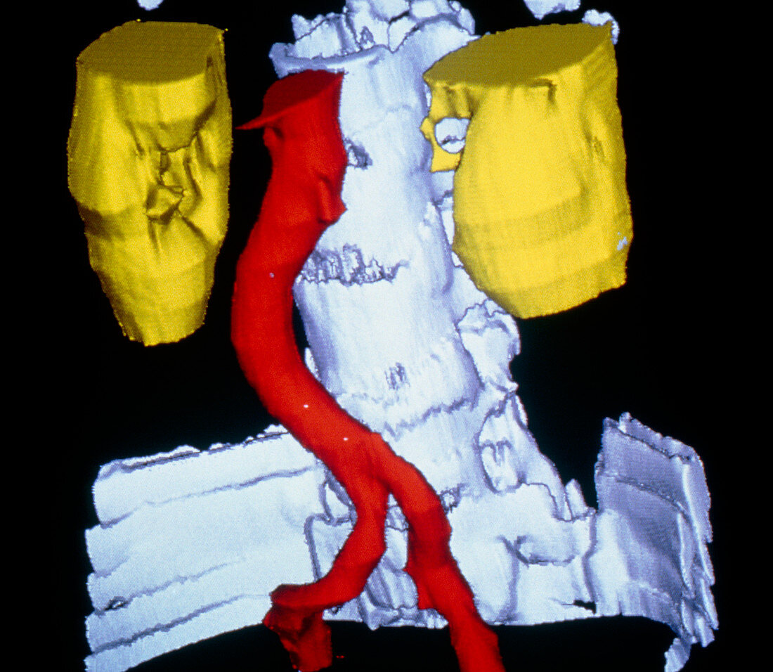 False-colour 3-D CT scan of kidneys & aorta