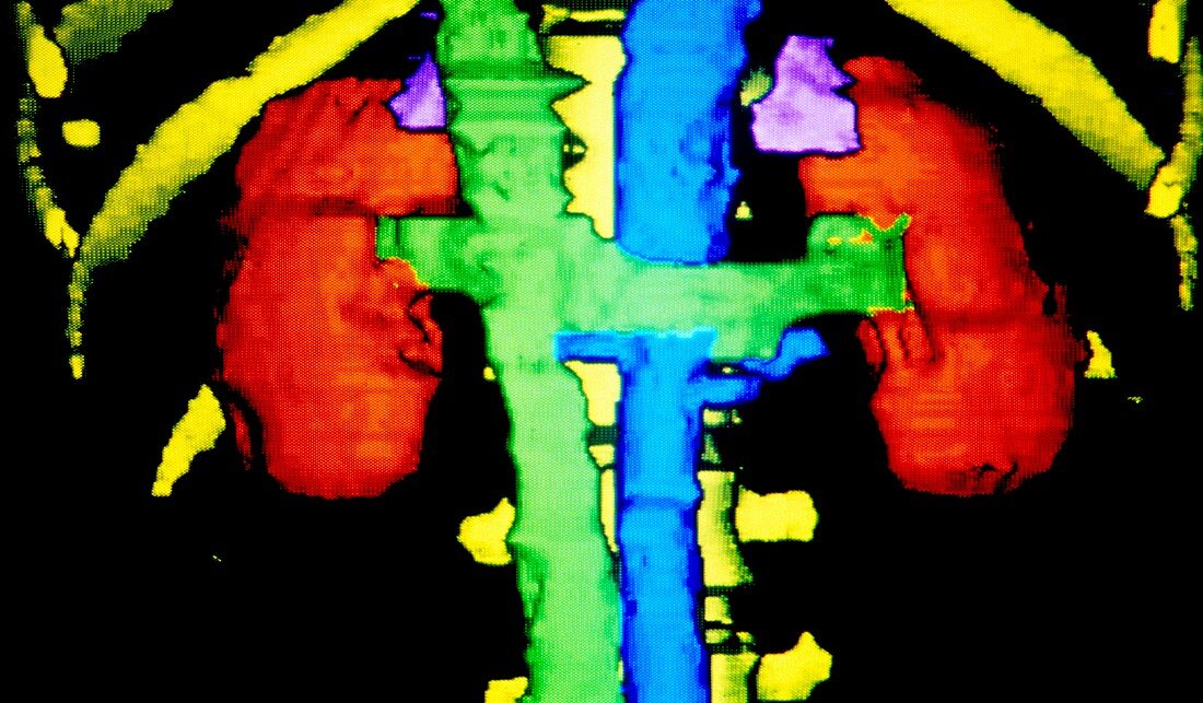Coloured 3-D CT scan showing healthy kidneys