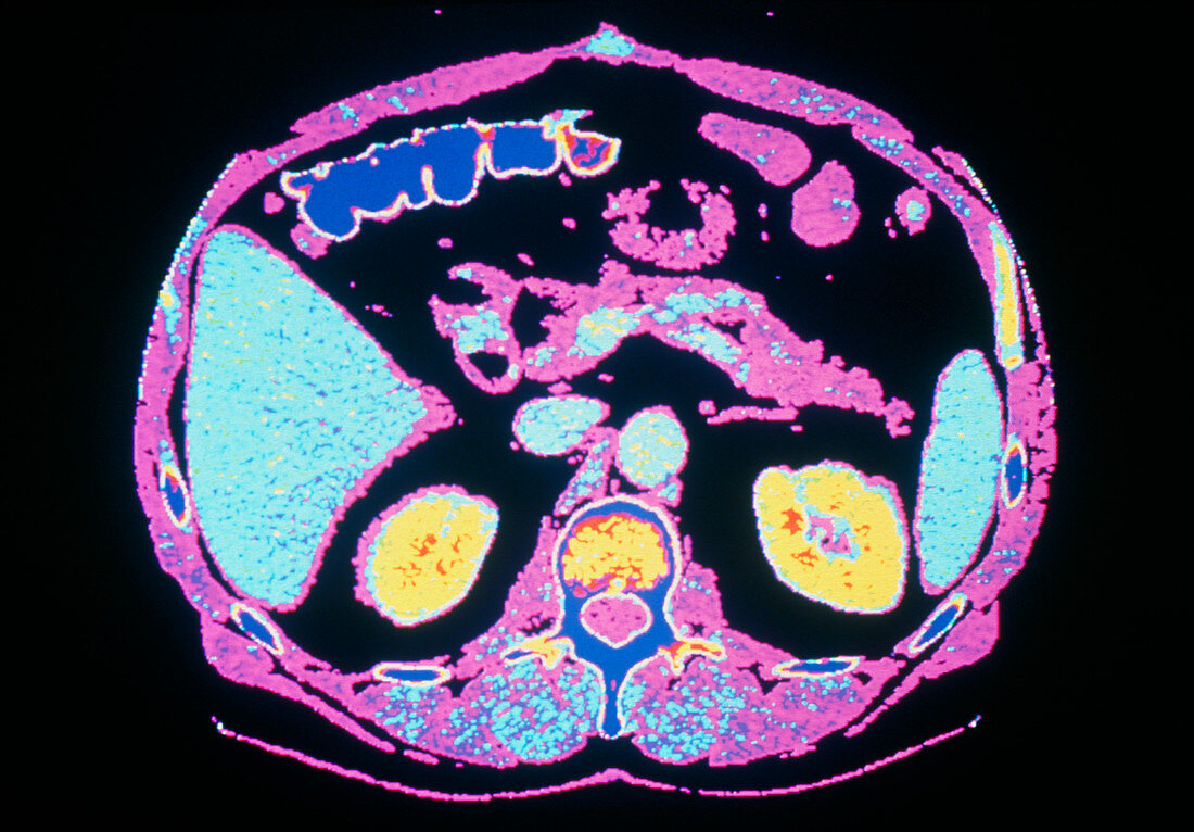 Computed tomography scan of kidneys in abdomen