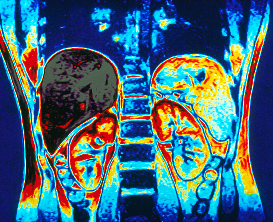 Colour MRI scan of abdomen showing kidneys & liver