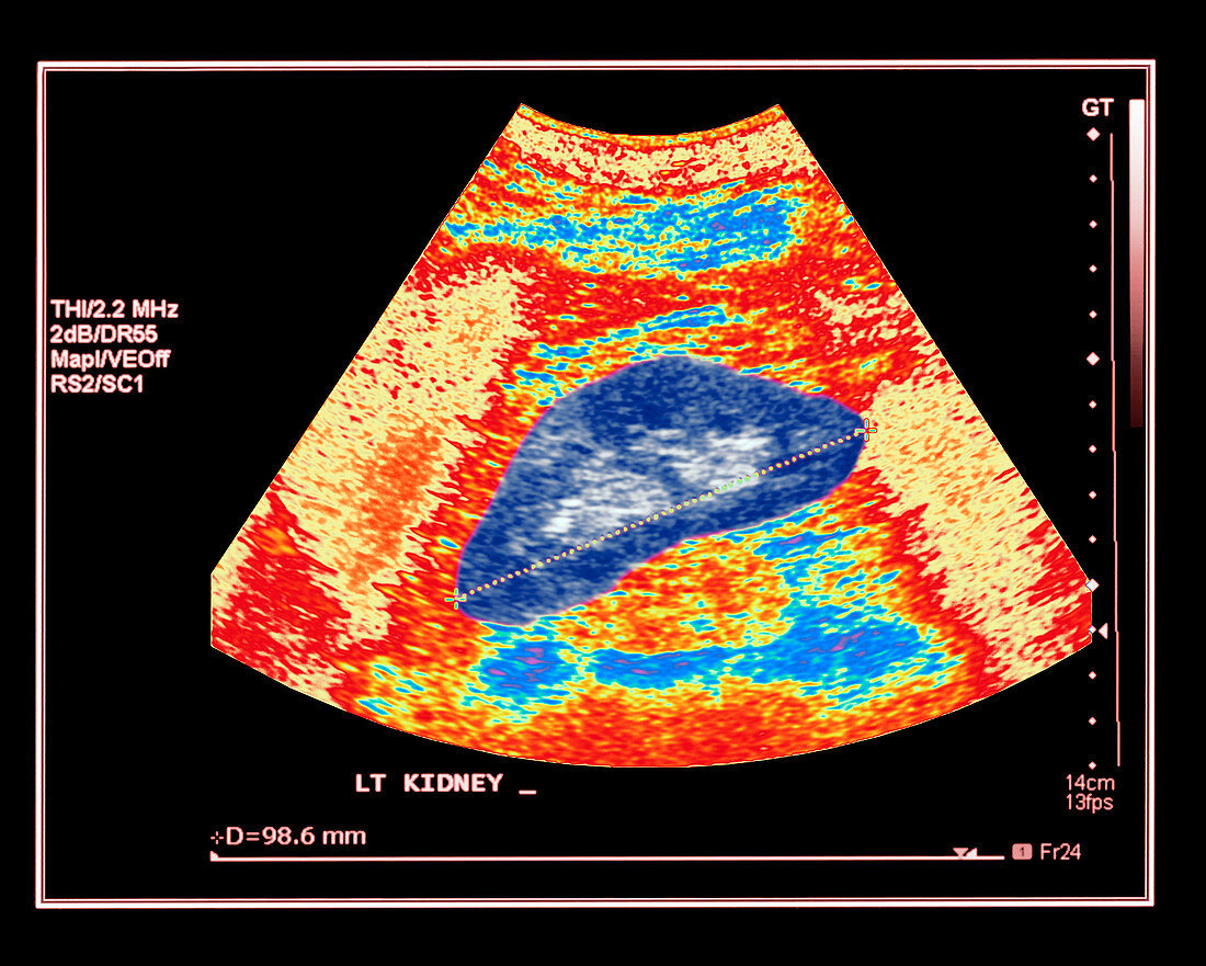 Healthy kidney measured,ultrasound scan