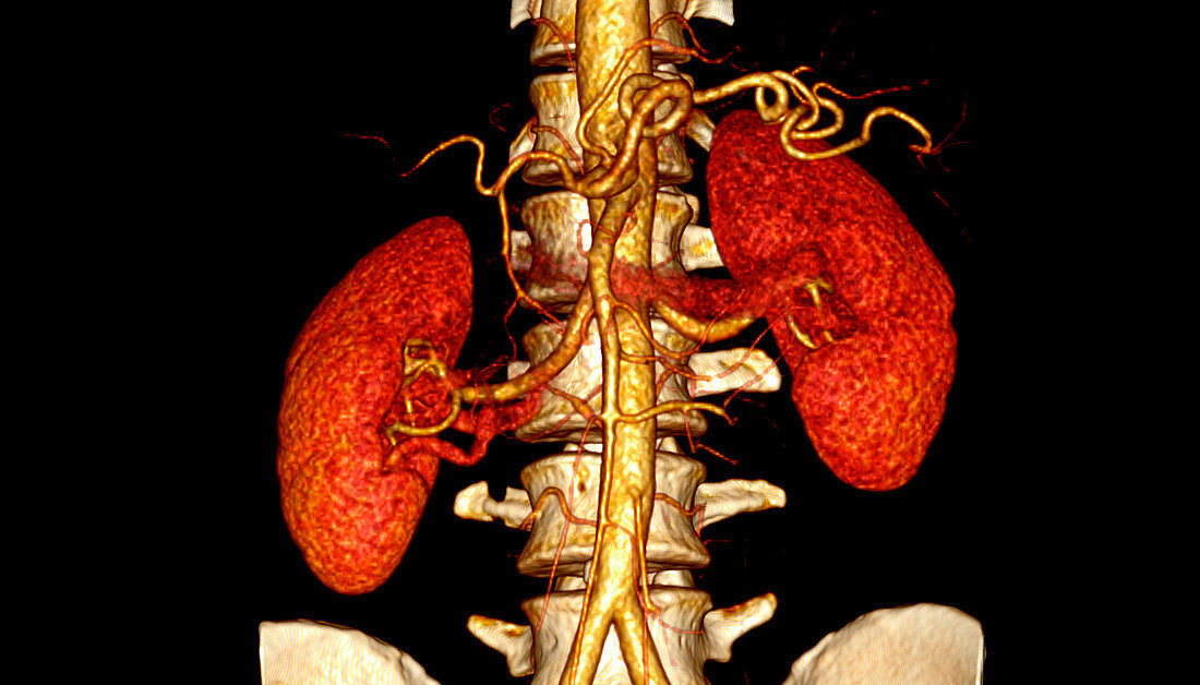 Kidneys,CT scan