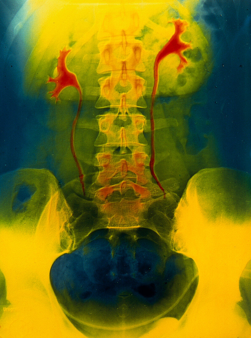 False-colour X-ray showing the kidneys & ureters