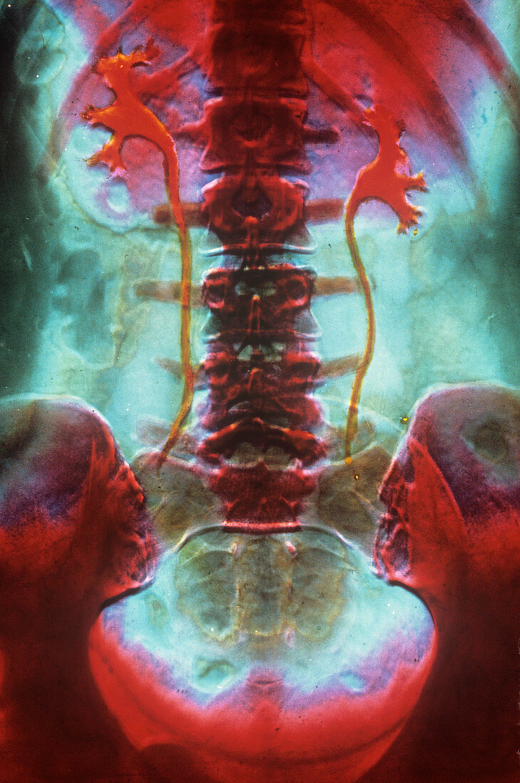 False-colour IVP showing the kidneys & ureters