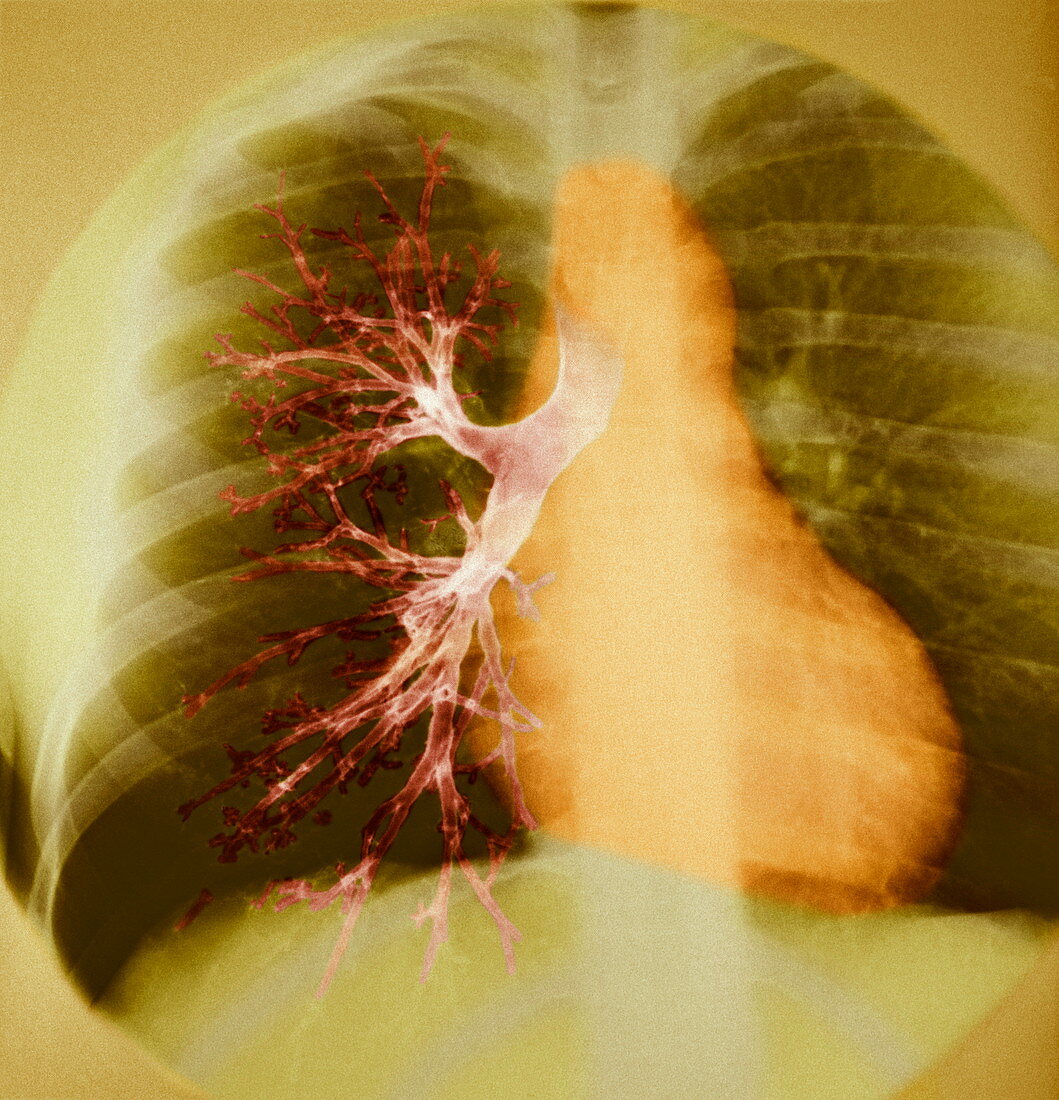 Lung,X-ray