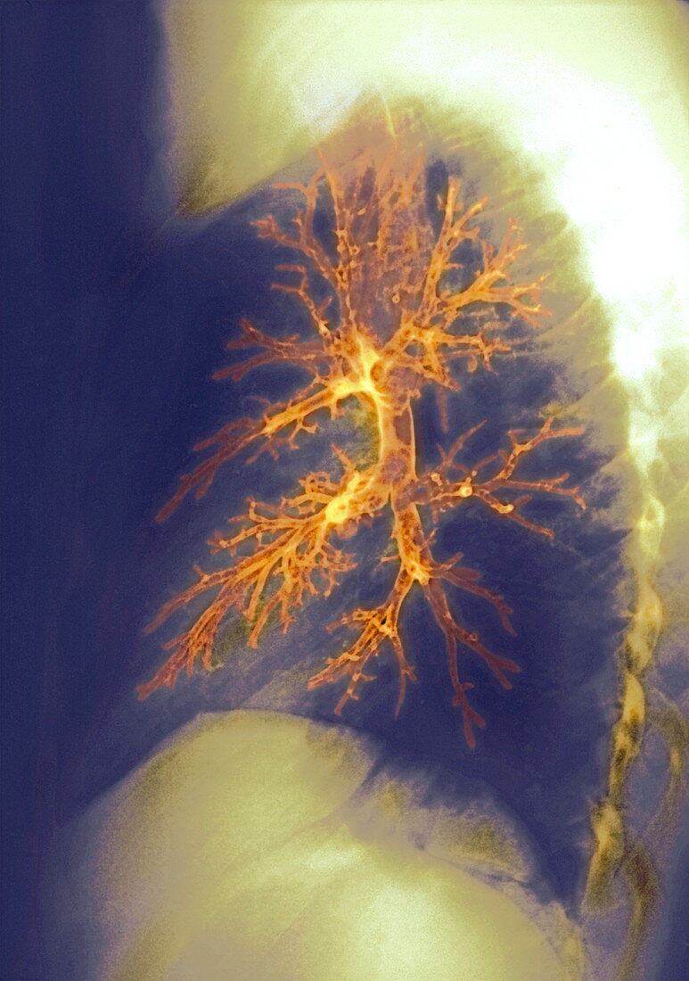 Lung,X-ray