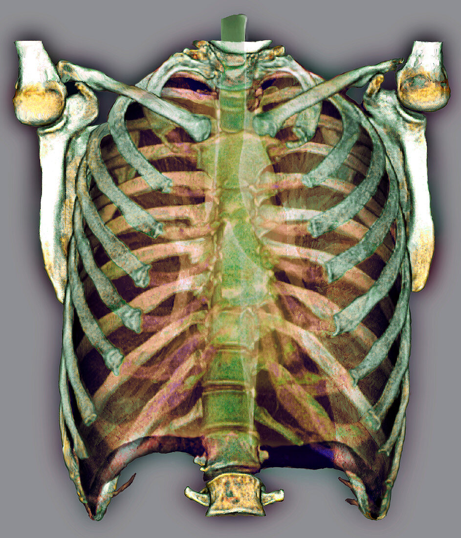 Trachea and rib cage,3D CT scan