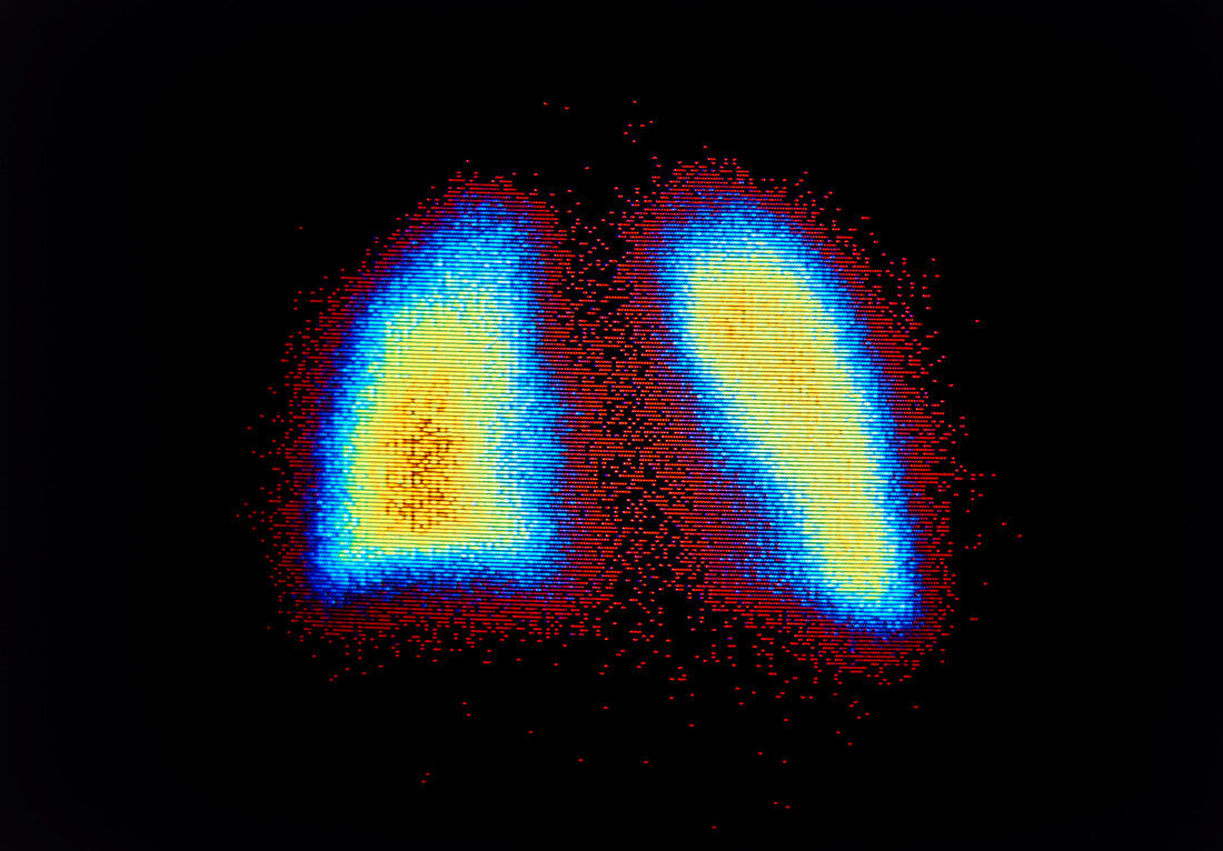 F/col scintigram of normal human lungs