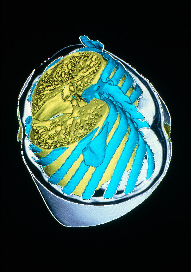 3-D CT scan of normal chest showing lungs