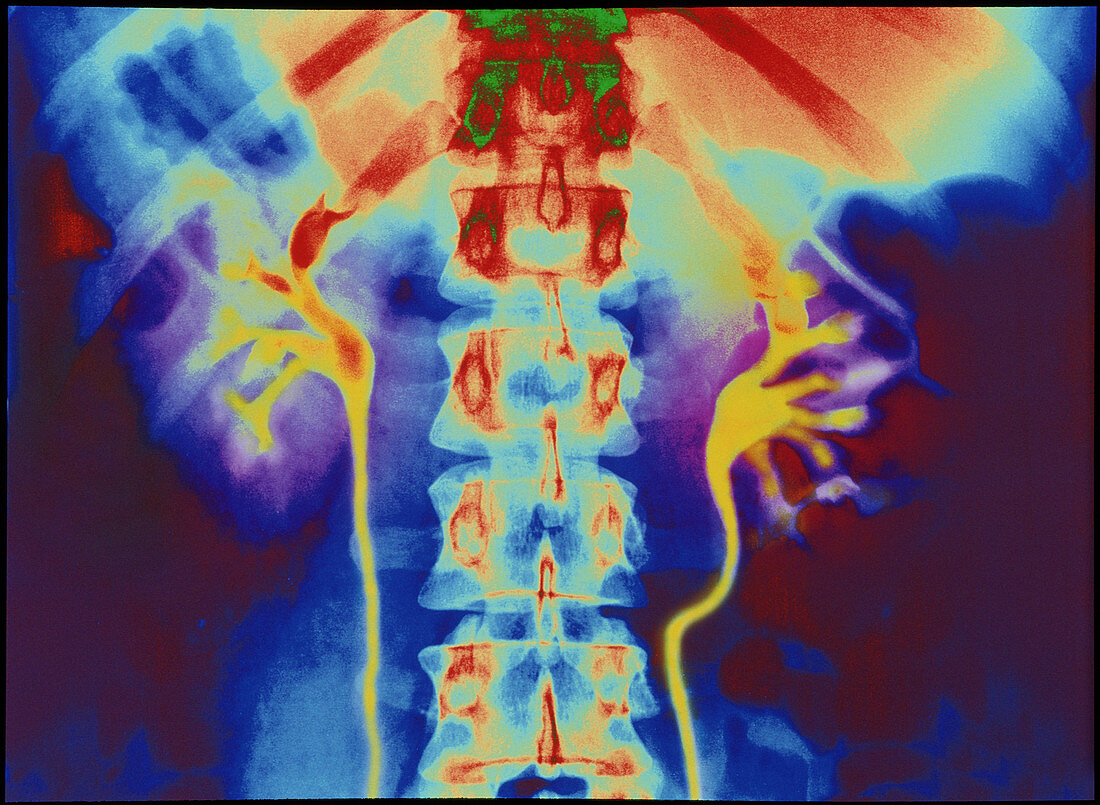 Coloured urogram X-ray of healthy human ureters