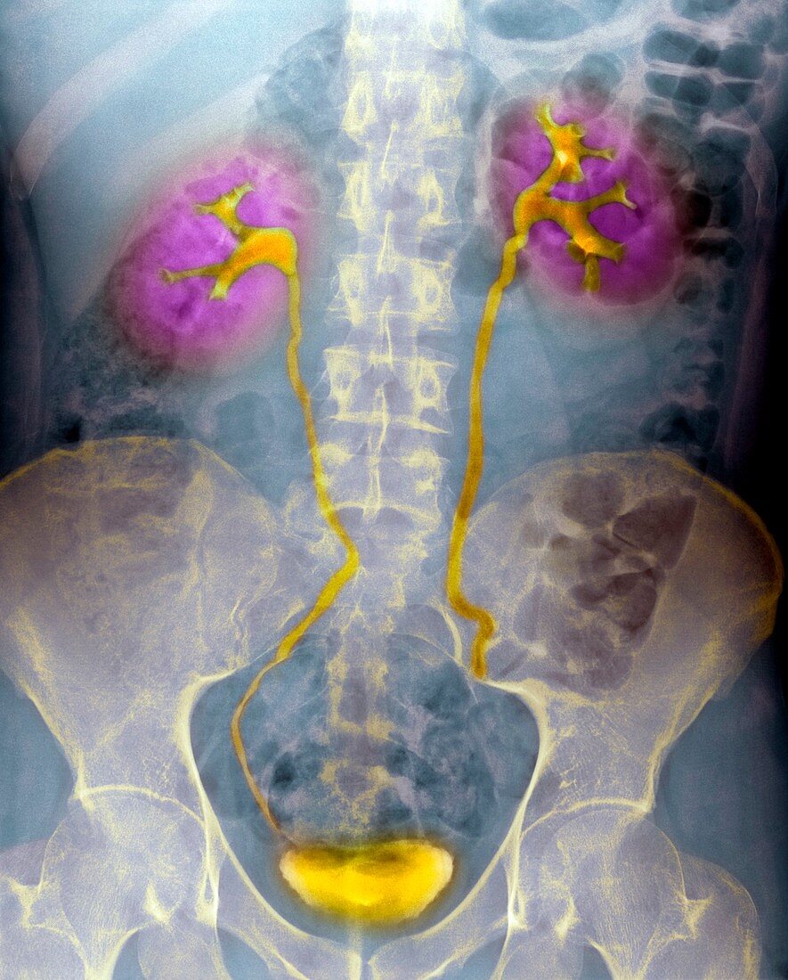 Urinary system,X-ray