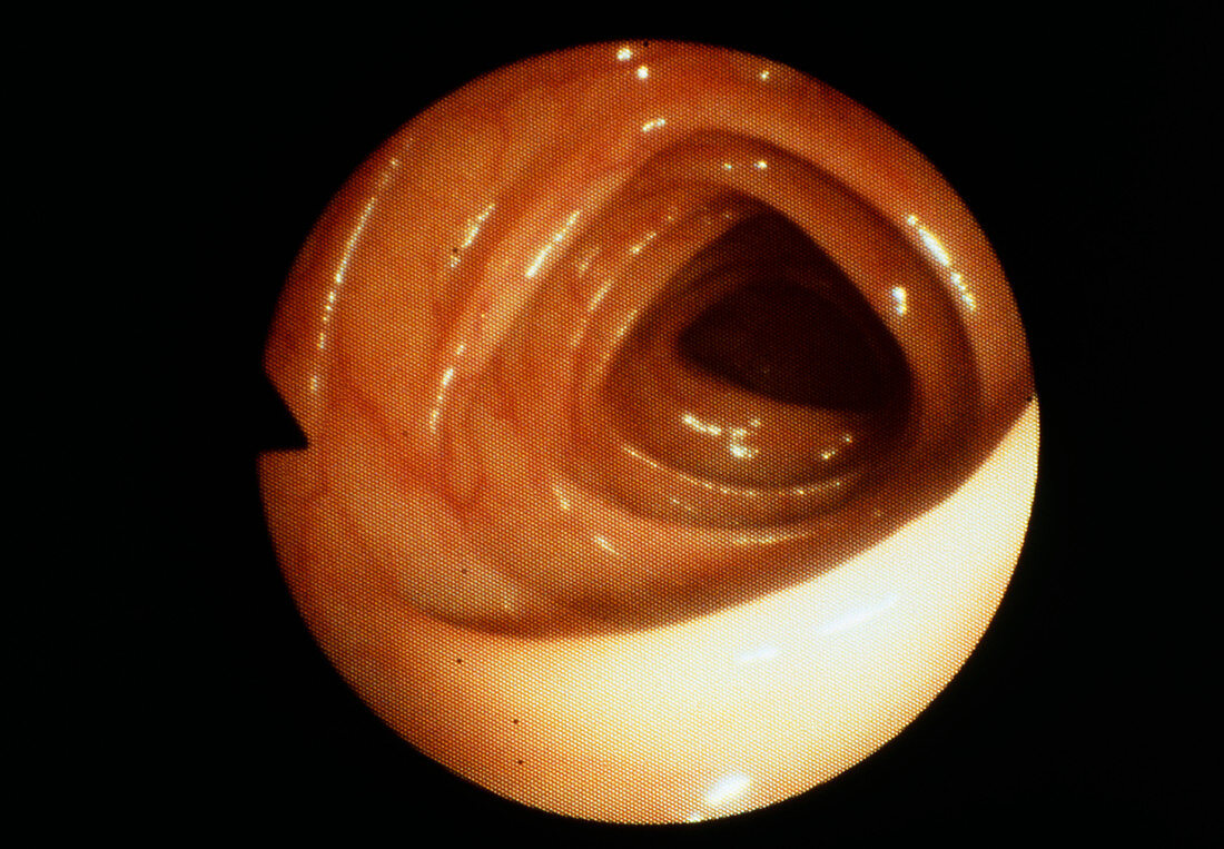 Endoscope image of the human colon
