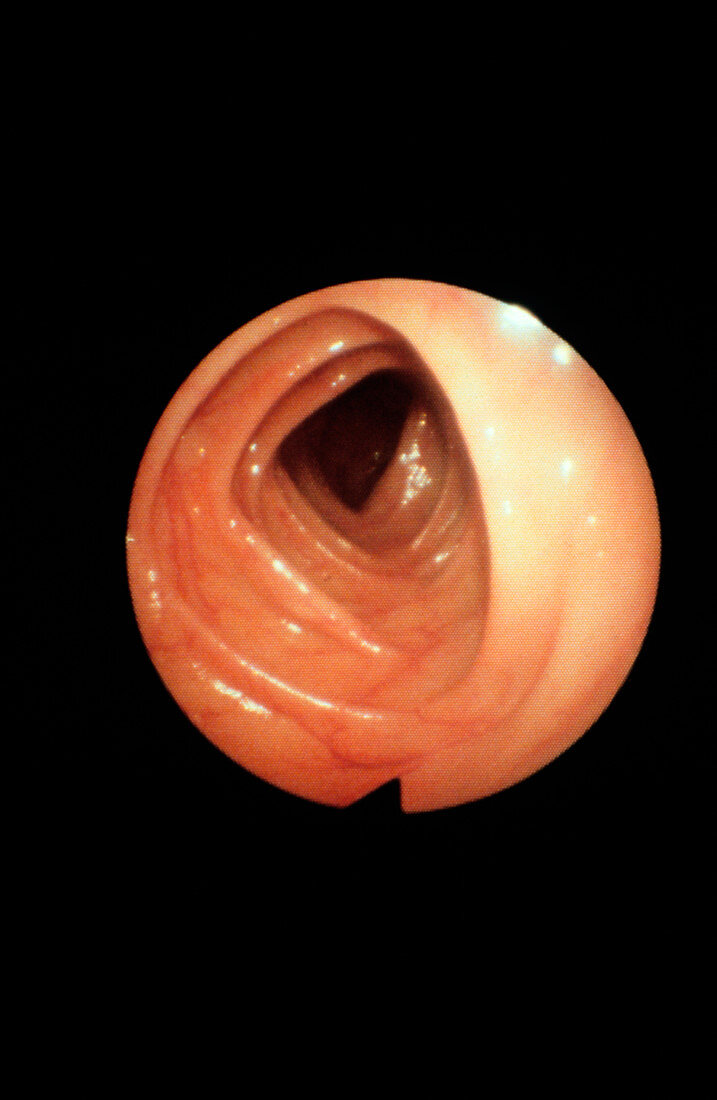 Endoscope image of normal transverse colon