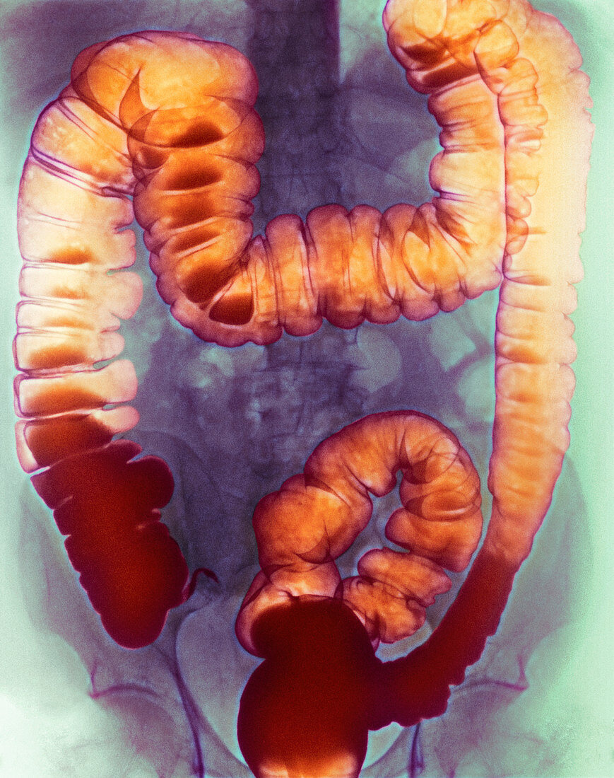 Large intestine,X-ray