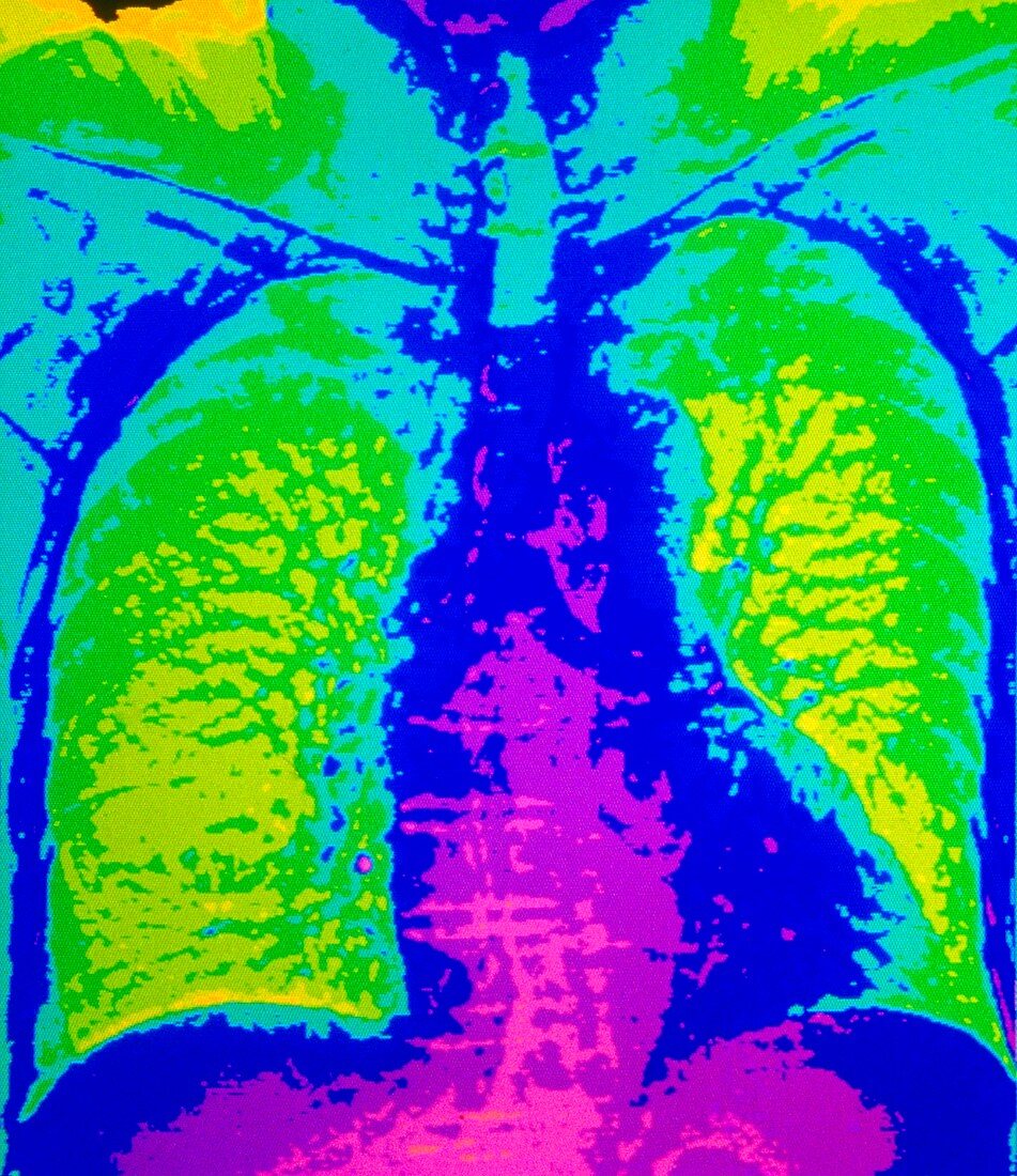 Coloured CT scan showing the lungs and heart