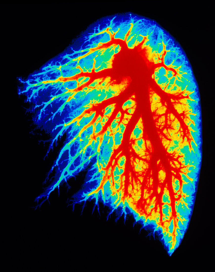 Coloured angiogram of pulmonary arteries of lung