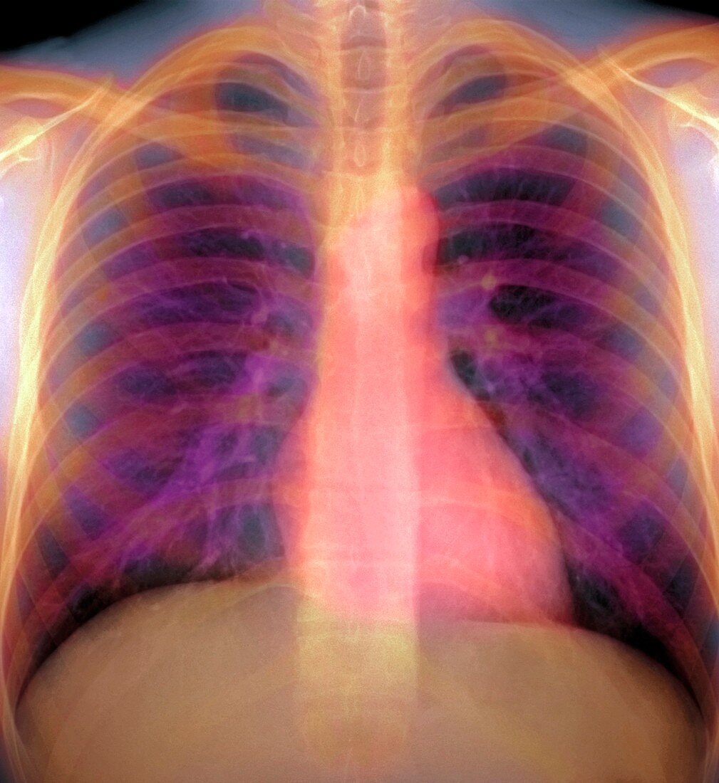 Lungs and heart,X-ray