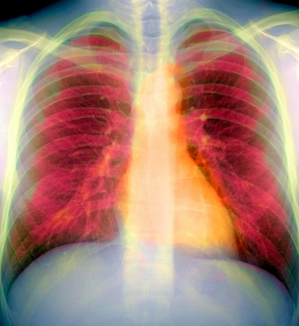 Lungs and heart,X-ray