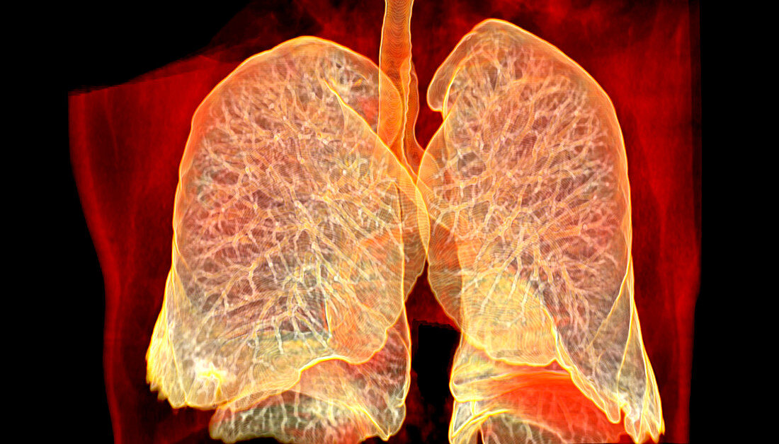 Lungs,CT scan