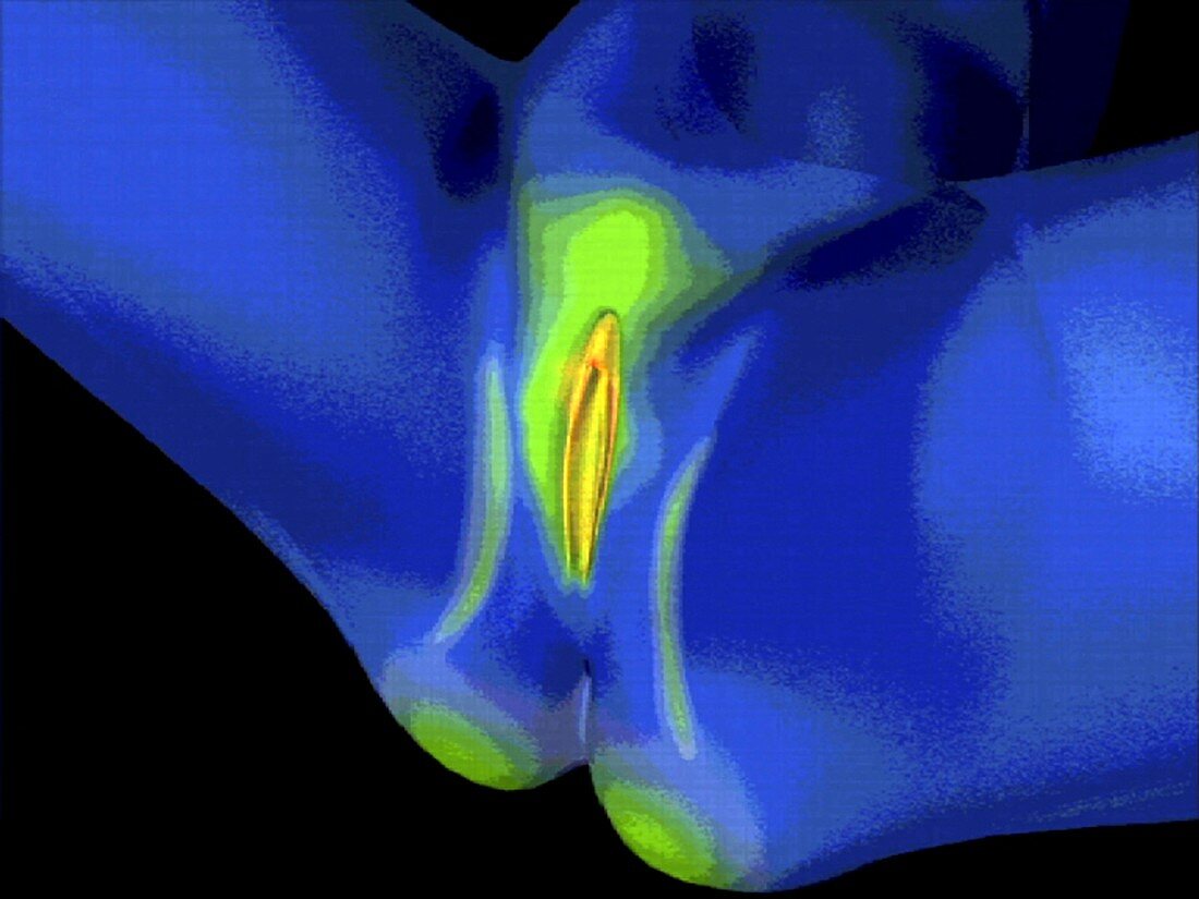 Female external genitalia,thermogram