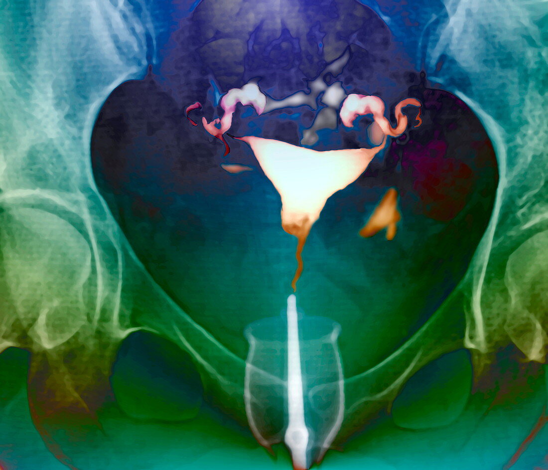 Female reproductive system,X-ray