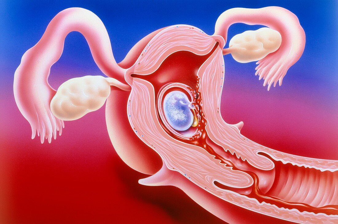 Illustration of abortion of an early embryo
