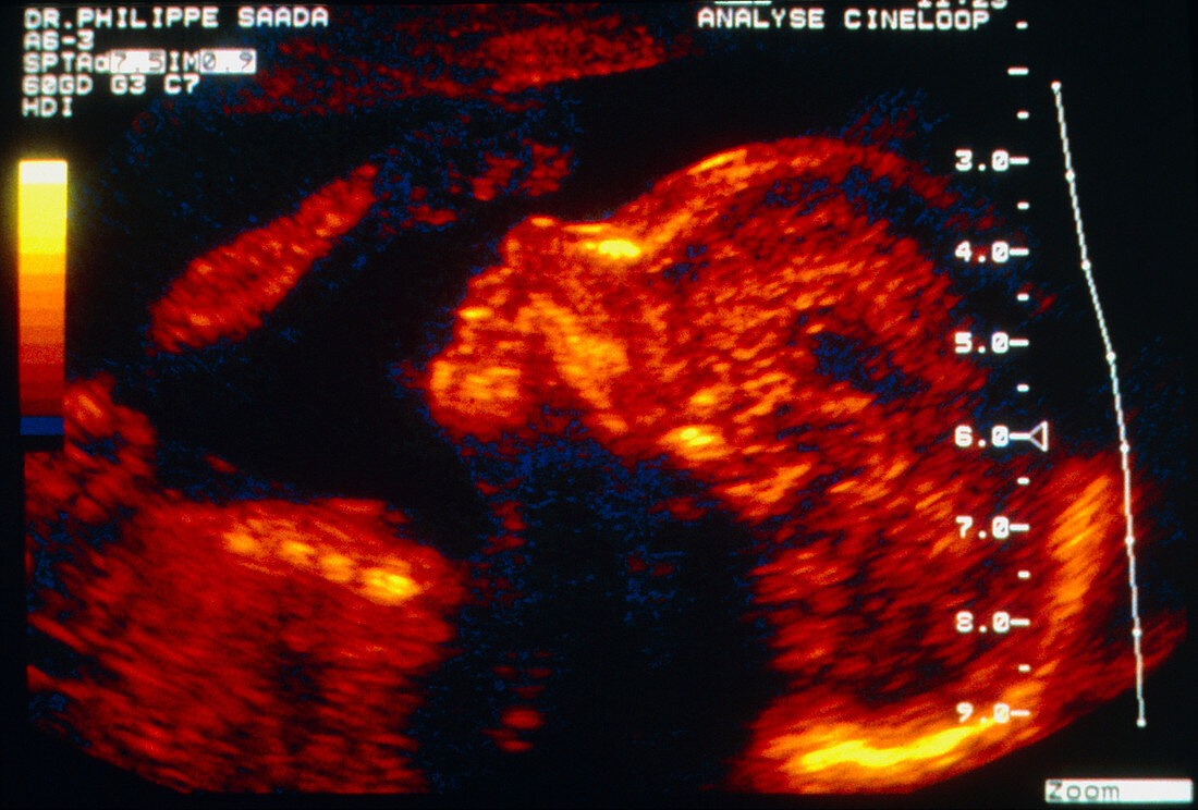 Colour ultrasound of foetal face at 5 months old