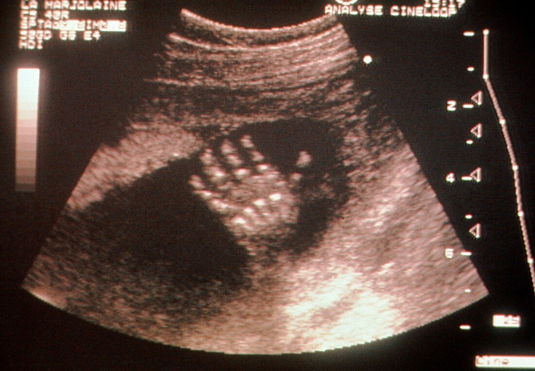 Ultrasound of 21 week old foetus's hand with bones