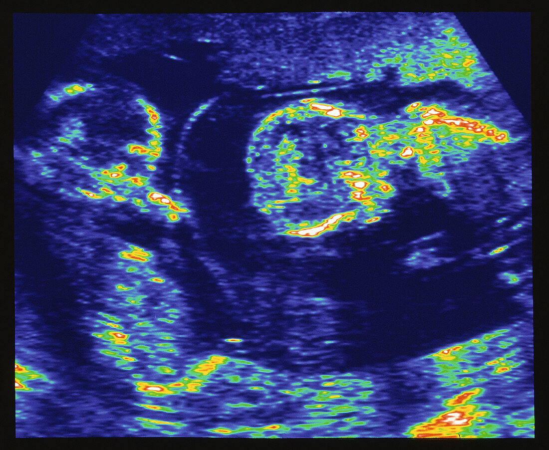 Ultrasound scan of a womb showing twins