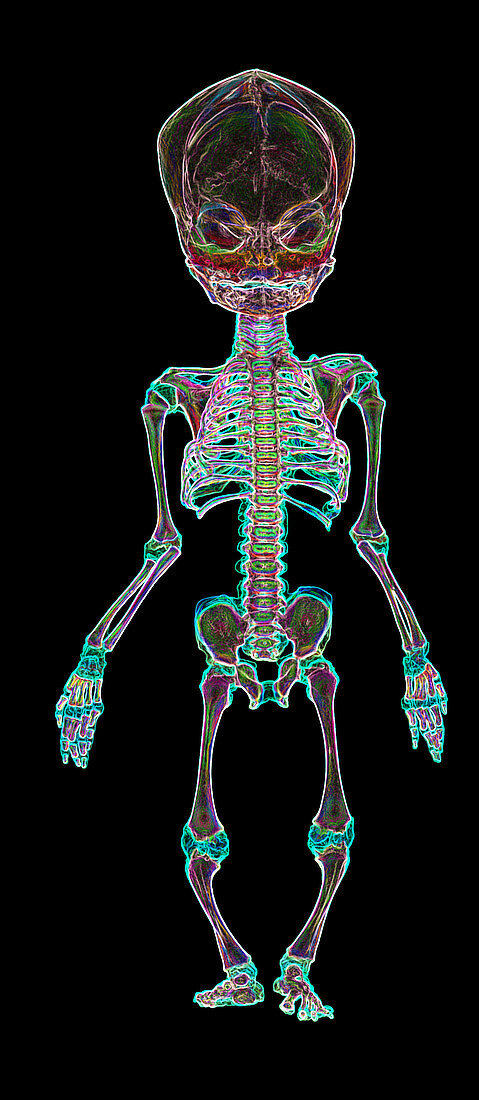 Coloured X-ray of a full-term stillborn foetus
