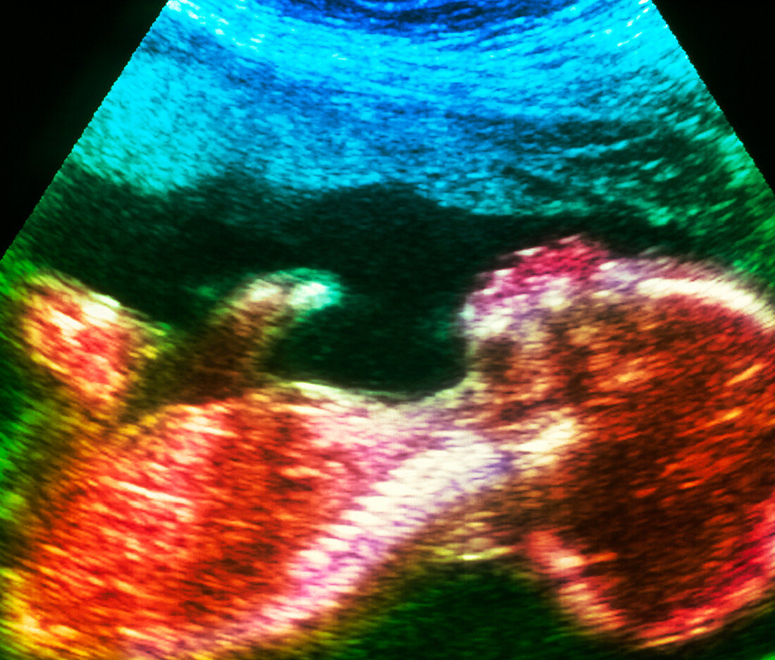 Ultrasound scan of 20 week old foetus (side view)