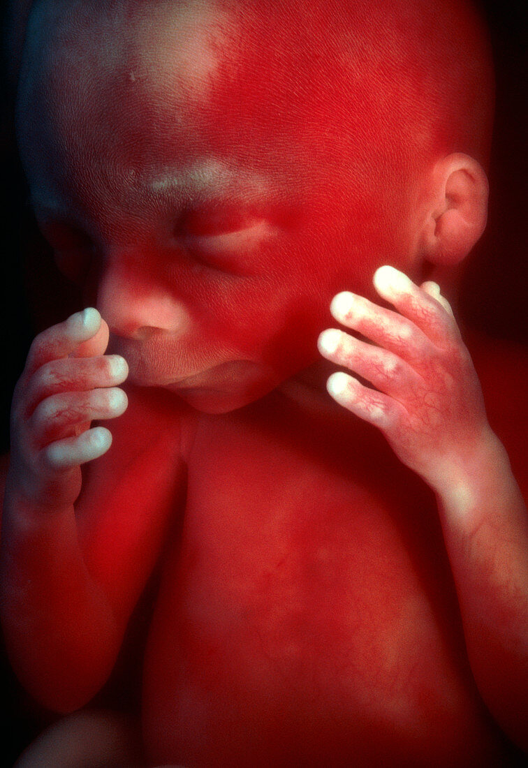Face and upper torso of a 19 week old male foetus